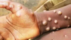 Türkiye'de Maymun Çiçeği Vakası Var Mı?